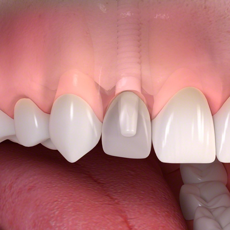 Featured image for “Considering Dental Implants? Don’t Miss Out on Ceramic Options”