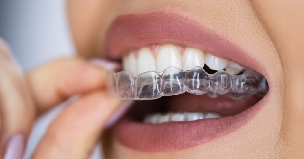 how clear aligners address complex orthodontic issues