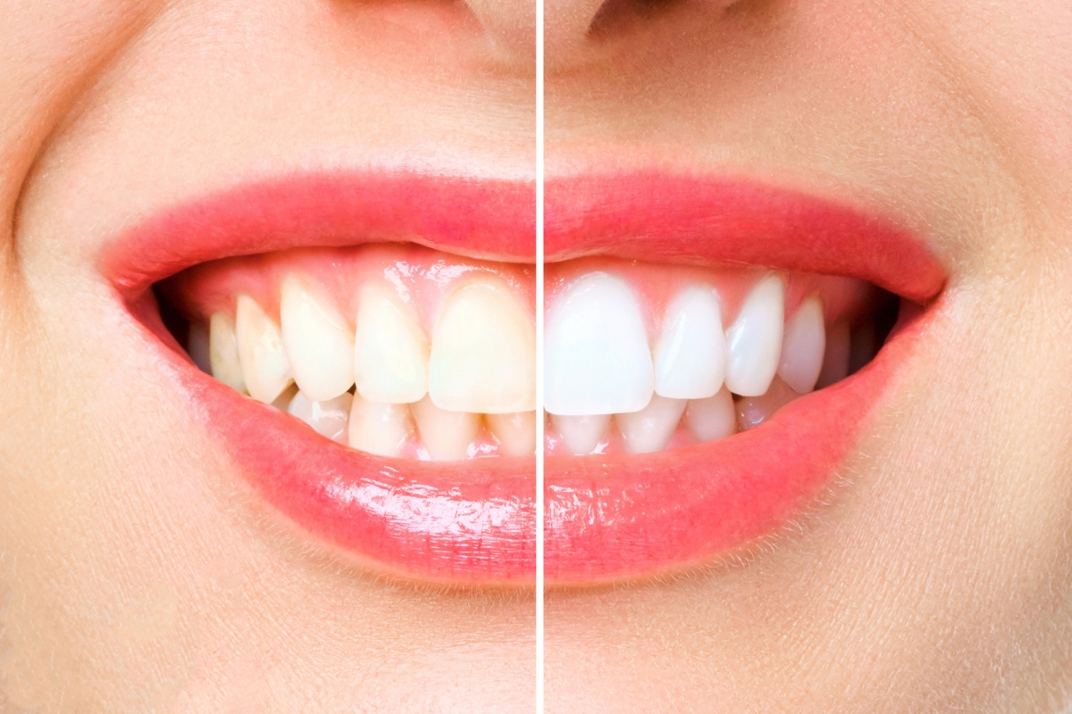 Featured image for “Whitening for Seniors: Safe Ways to Restore Youthful Brightness”