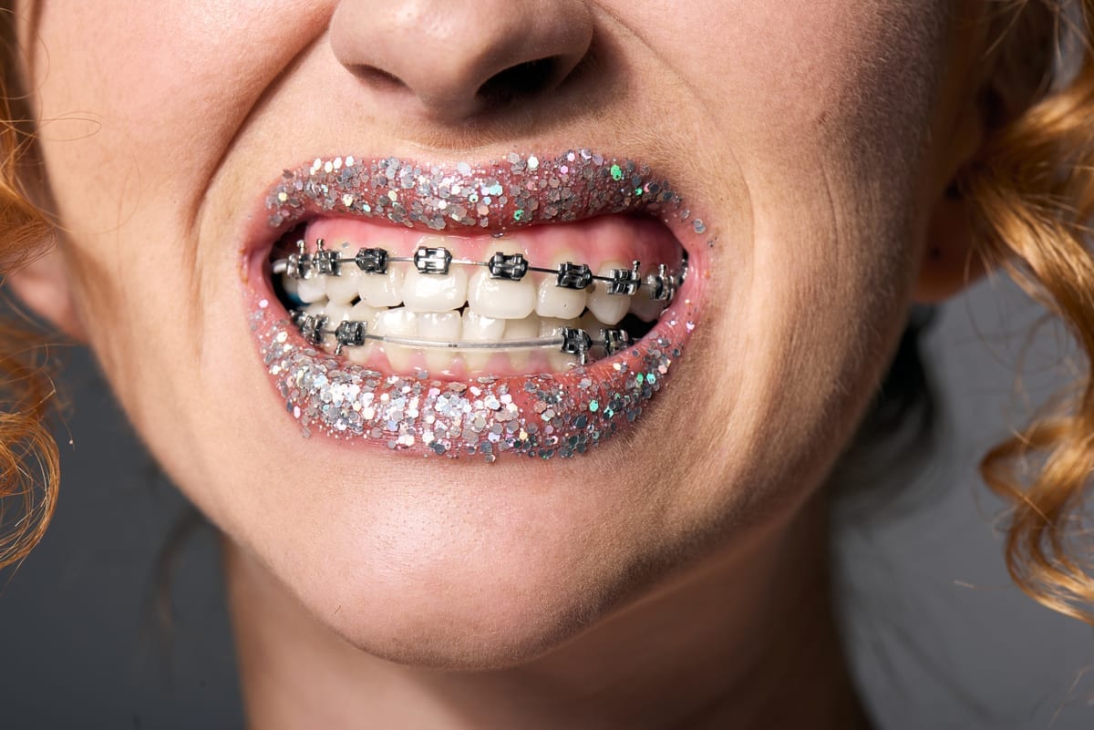 Featured image for “Braces Results Longevity in Vernon, CT | Dr. Jay Family Dental”