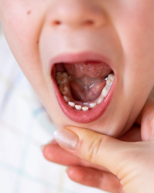 How Can a Tongue Tie Affect Children and Adults?