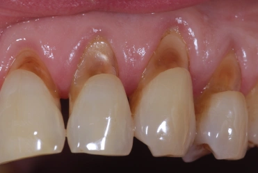 Abfractions or chipping of the enamel near the gums