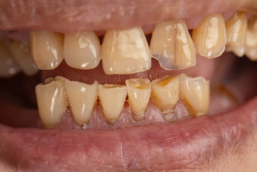 Bruxism