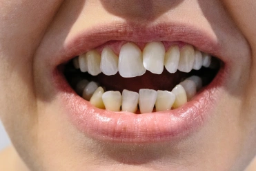 Crowding of teeth