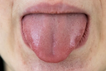 Enlarged tongue