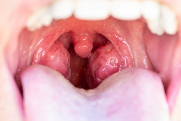 Large tonsils