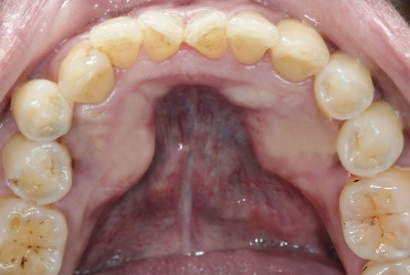 Mandibular or maxillary torus of the jaws