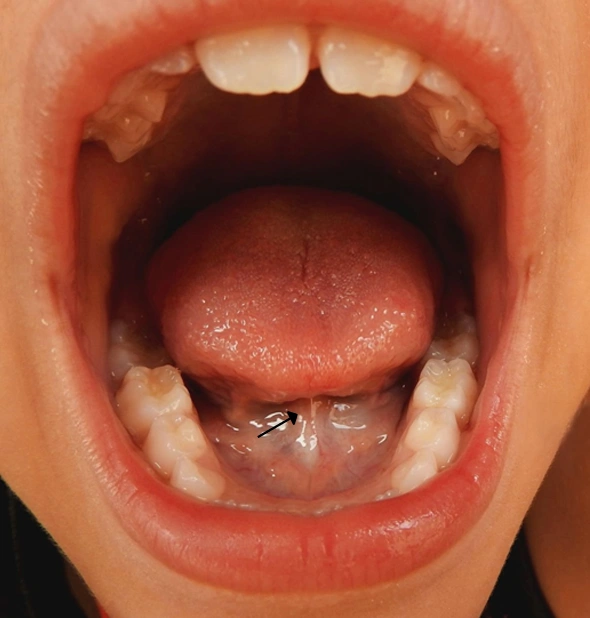 What Is a Tongue Tie?
